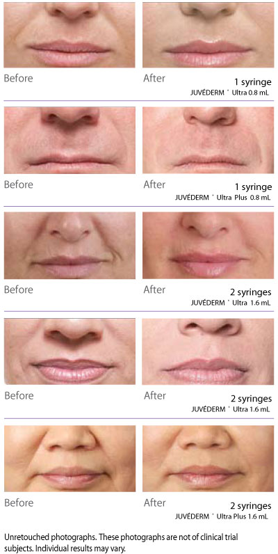 Juvederm Ultra Plus